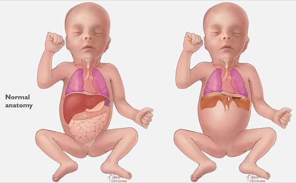 Congenital diaphragmatic hernia occurs when the muscle separating the abdomen and chest cavities does not form or forms with a hole in it. Some of the organs in the abdomen push through the hole into the chest, crowding the lungs and causing them to develop poorly.